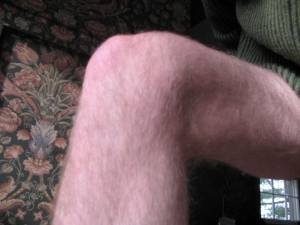 my-knee The body part in question a week after the fact.